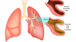 Ilustrasi bronkitis. (Sumber: KlikDokter)