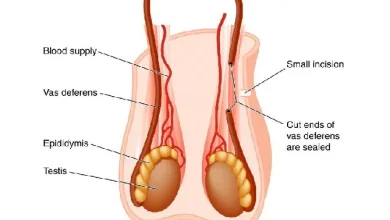 Ilutrasi Vasektomi. (Sumber: TheAsianParent)