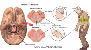 Gambar penyakit Parkinson. (Sumber: RSUD Dr. Soedirman)