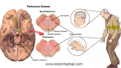 Gambar penyakit Parkinson. (Sumber: RSUD Dr. Soedirman)