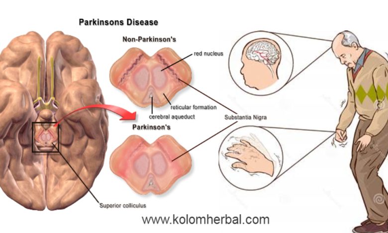 Gambar penyakit Parkinson. (Sumber: RSUD Dr. Soedirman)